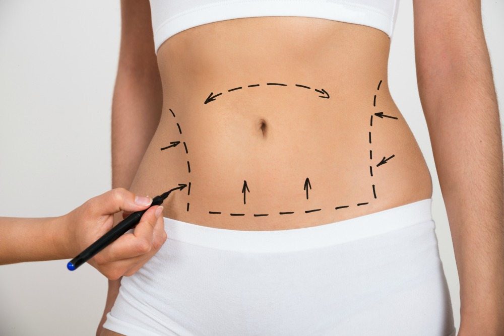 After the Tummy Tuck: The Exercises that help Your Recovery